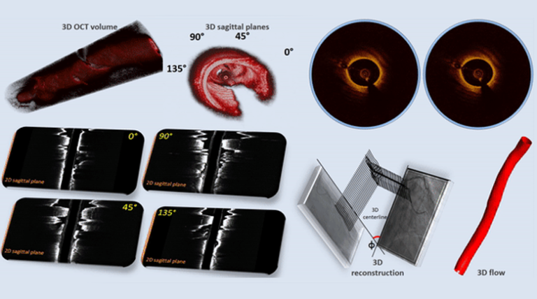 Optimized Automated Segmentation and 3D Reconstruction Using Intracoronary Optical Coherence Tomography