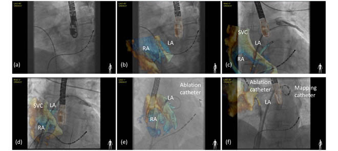 A novel, validated image fusion system that allows real-time integration of three-dimensional echocardiography and X-ray fluoroscopy for guidance of cardiac cacheterization. The system was validated in two stages: pre-clinical to determine function and validate accuracy, and in the clinical setting to assess clinical workflow feasibility and determine overall system accuracy.