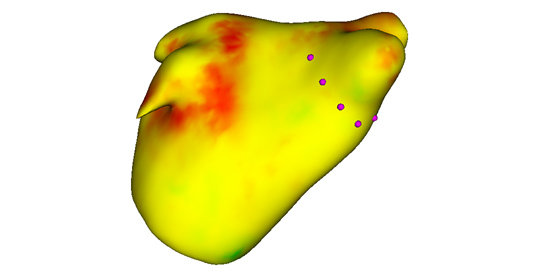 Figure shows a heat map of the left atrium, generated from the algorithm, showing likely areas of scar. Purple stylized dots represent potential sites of ablation based on the scar distribution.