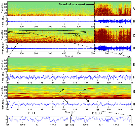 Panel B shows 12 minutes of bipolar EEG from Fp2-F4 (1-70 Hz, 200 S/s). Panel A is the corresponding spectrogram. Panel E shows 30 seconds of EEG from Panel B at the onset of the generalized seizure (dashed line). Panels C, D, and F are the corresponding tEEG signals from Fp2’ (1-100 Hz, 200 S/s). Note the high gamma-band burst HFOs just prior to the partial seizure (highlighted by ellipse in panel C).