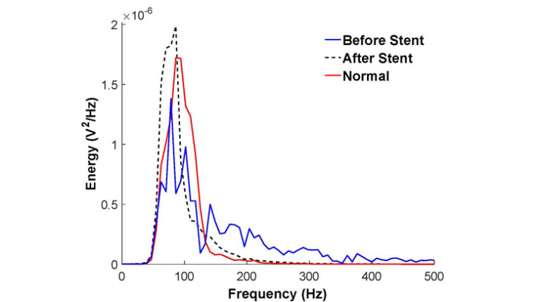 The Assessment of Stent Effectiveness Using a Wearable Beamforming MEMS Microphone Array System