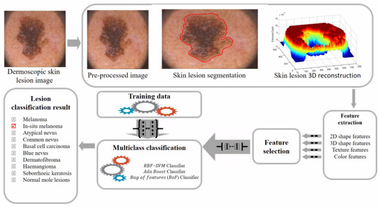 Melanoma Is Skin Deep: A 3D Reconstruction Technique for Computerized Dermoscopic Skin Lesion Classification