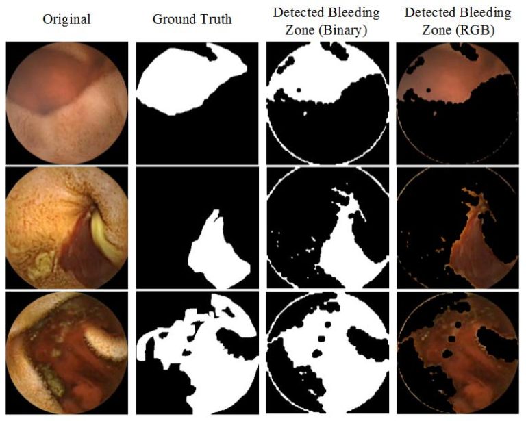 CHOBS: Color Histogram of Block Statistics for Automatic Bleeding Detection in Wireless Capsule Endoscopy Video