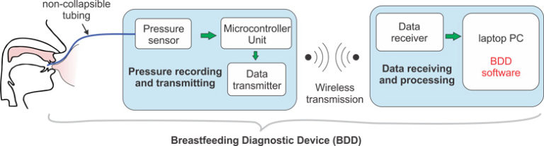 Fig. 1. Schematic diagram of the breastfeeding diagnostic device (BDD) consisting of a pressure recording and transmitting unit and a data receiving and processing unit. Intraoral pressure is probed by an air-filled non-collapsible tubing with one end taped to the maternal or bottle nipple and the other end connected to a silicon-based pressure transducer. The measured pressure value is digitized and transmitted wirelessly to the data receiving and processing unit for data display, processing, storage and interface with users.