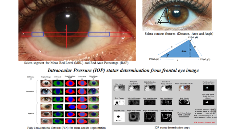 Automated Vision-Based High Intraocular Pressure Detection Using Frontal Eye Images