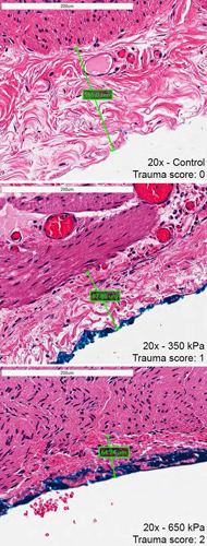 Defining the Relationship Between Compressive Stress and Tissue Trauma During Laparoscopic Surgery Using Human Large Intestine