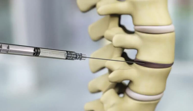 Noninvasive Injectables for Chronic Low Back Pain