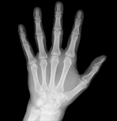 Automatic Quantification of Radiographic Finger Joint Space Width of Patients with Early Rheumatoid Arthritis