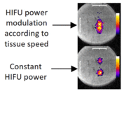 Self-scanned HIFU ablation of moving tissue using real-time hybrid US-MR imaging