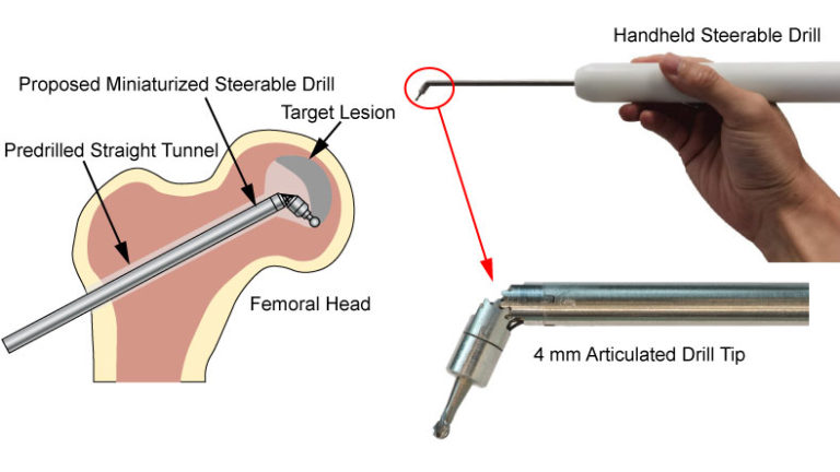 A Handheld Steerable Surgical Drill With a Novel Miniaturized Articulated Joint Module for Dexterous Confined-Space Bone Work
