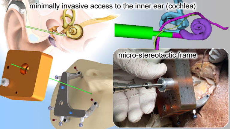 Ex vivo evaluation of a minimally invasive approach for cochlear implant surgery
