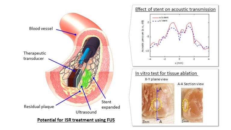 Intravascular Sono-Ablation for In-Stent Restenosis Relief: Transducer Development and the In-Vitro Demonstration