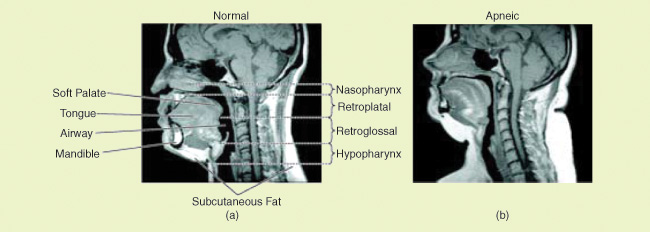 FIGURE 1: A midsagittal magnetic resonance image (MR I) (a) in a normal subject and (b) in a patient with severe OS A. Highlighted are the four UA regions (nasopharynx, retropalatal region, retroglossal region, and hypopharynx), UA soft tissue (soft palate, tongue, and fat), and craniofacial structures (mandible). Fat deposits are shown in white on the MR I. Note that in the apneic patient: (a) the UA is smaller in both the retropalatal and retroglossal region, (b) the soft palate is longer and the tongue size is larger, and (c) the quantity of subcutaneous fat is greater. (Images from [2, Fig. 3] and [3] and reprinted with permission of the American Thoracic Society. Copyright © 2014 American Thoracic Society.)