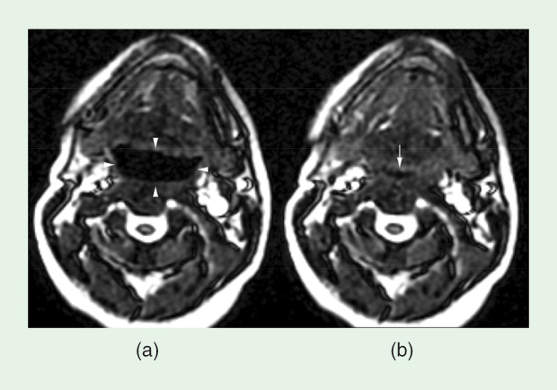 FIGURE 1: Real-time 2-D imaging of the airway during a breathing cycle. Shown here are axial images from a 13-year-old male with Down syndrome and severe OSA by polysomnography. The airway is seen during (a) expiration (arrowheads) and (b) early inspiration (arrow). The pattern of collapse in this patient is primarily anterior–posterior (glossoptosis). Please also see Movies 1, 2, and 3, in IEEE Xplore, which respectively contain midline sagittal, axial retroglossal, and axial nasopharyngeal screenshots from this patient. The sagittal screenshot shows dynamic motion but incomplete collapse. The axial retroglossal one shows dynamic motion with complete collapse. The axial nasopharyngeal screenshot shows moderate dynamics and incomplete collapse. (Image courtesy of Robert J. Fleck.)