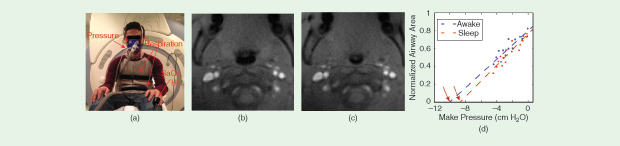 FIGURE 3: Airway compliance can be actively tested using an inspiratory load and ultrafast 2-D imaging. The apparatus consists of a (a) face mask with pressure transducer, and a controller in the MR I operator room (not shown). Shown here are axial images from a 15-year-old female primary snorer (b) before occlusion and (c) maximal narrowing during the occlusion. Please also see Movie 5 in IEEE Xplore. Segmentation of these images enables estimation of the (d) pressure–airway area relationship, which can be determined by performing a linear regression from all data during a single occluded breath. Notice that the estimated airway closing pressure (arrows) in this subject is higher during sleep (red) than when awake (blue). (Images courtesy of Krishna S. Nayak.)