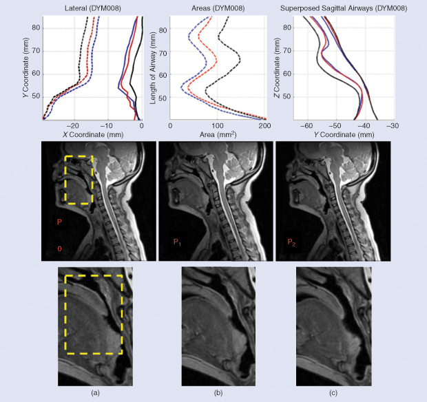 FIGURE 1: An MRI of the upper airway under atmospheric pressure and two PAPs: (a) the displacement of the lateral walls, (b) the change in the cross-sectional area along the length of the airway, and (c) the displacement of the anterior and posterior walls. The blue line denotes atmospheric pressure, the red line denotes low-level positive pressure, and the black line denotes high positive pressure.