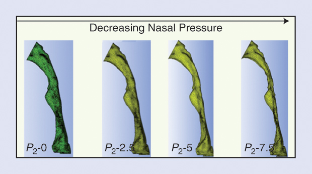 FIGURE 2: Model-predicted responses of the upper airway to different levels of closing pressures.