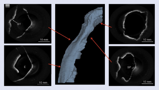 FIGURE 4: In vivo OCT images of a human upper airway: two-dimensional cross section and 3-D rendering profile view from in vivo data. The epiglottis (E), base of tongue (BT ), and soft palate (SP ) are labeled. The probe is inserted into the airway from the nasal cavity down to the level of the epiglottis. The probe is translated through the airway, passing through the laryngopharynx, past the pharynx, and through the nasopharynx.
