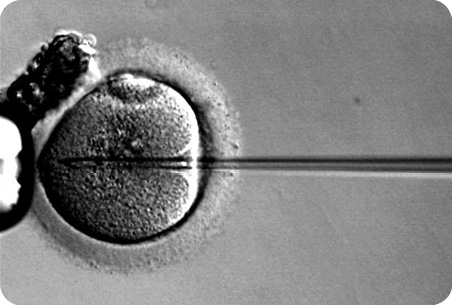 After some less-than-successful attempts to fertilize frozen eggs, interest in oocyte cryopreservation returned once ICSI resulted in the first births in the early 1990s. In ICSI, sperm are injected directly into the egg as shown. Cryopreservation began with slow-freezing techniques and has not expanded to quick-freezing, known as vitrification. (Image courtesy of the Robert Wood Johnson Medical School IVF Laboratory.)