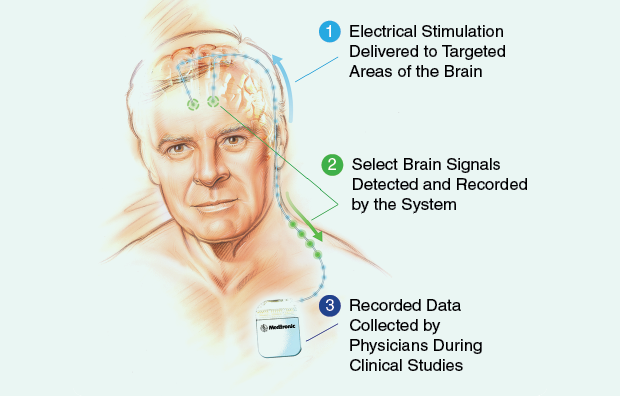 Medtronic’s brain-stimulating and recording system is part of a new generation of DBS technologies that may be able to provide researchers crucial information about the brain’s behavior during stimulation and ultimately help them optimize therapies. (Image courtesy of Medtronic.)