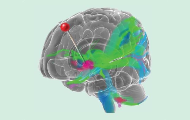 The NAcc and subgenual cingulate cortex targets highlighted through an fMRI diffusion tensor imaging model. (Image courtesy of AMI USC, 2014.)
