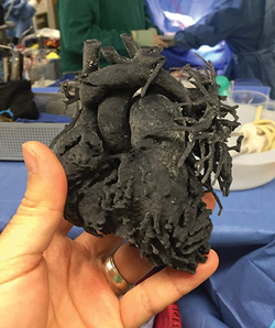 A 3-D printed model of a young patient's heart, made of flexible material, was used by Dr. Redmond Burke, director of cardiovascular surgery at miami Children's Hospital, to plan a complex surgery to repair multiple defects. (Photo courtesy of miami Children's Hospital.)