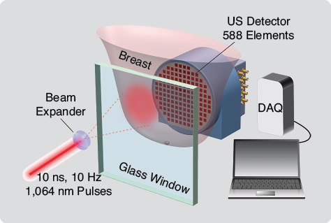 A schematic of the imager of the Twente PAM: The breast is immobilized between a glass window and a US detector matrix. Light at 1,064 nm from a Q-switched Nd:YAG laser expanded to a diameter of 70 mm illuminates the breast through the window. The 588 detector elements are arranged in a diameter of roughly 85 mm. Analog front-end electronics are mounted close to the detection elements, and the data is digitized and read into the computer, using a data acquisition system (DAQ), for off-line image reconstruction.