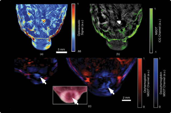 Dynamic contrast enhancement in nude mice with 4T1 tumors. (a) Single-pulse images obtained at 790 nm approximately 30 seconds after ICG injection and (b) multispectrally resolved ICG signal is overlaid in green. The spectrally resolved oxyhemoglobin (red) and deoxyhemoglobin (blue) within the tumor on days six (left) and 13 (right) demonstrate the label-free imaging capabilities of MSOT. (c) A photo of the cryoslicing through the tumor. The arrows indicate the hypoxic regions of the tumor core. (Figure adapted from [13].)
