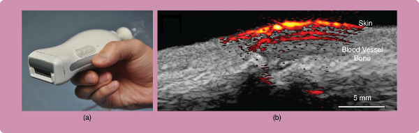 (a) a handheld probe integrating a pulsed diode laser and a US detection array. (b) a PA/US image of a human finger proximal interphalangeal joint in the sagittal plane. The red and orange (heat) colors indicate PA data, while the gray color indicates the US data. (Figure reproduced with permission from [3].)