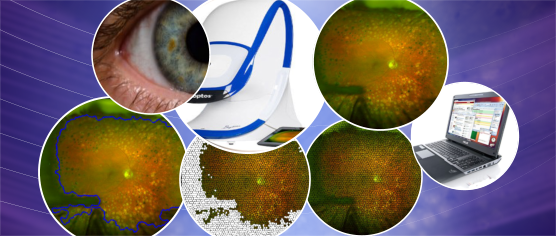 Retinal Area Detector from Scanning Laser Ophthalmoscope (SLO) Images for Diagnosing Retinal Diseases