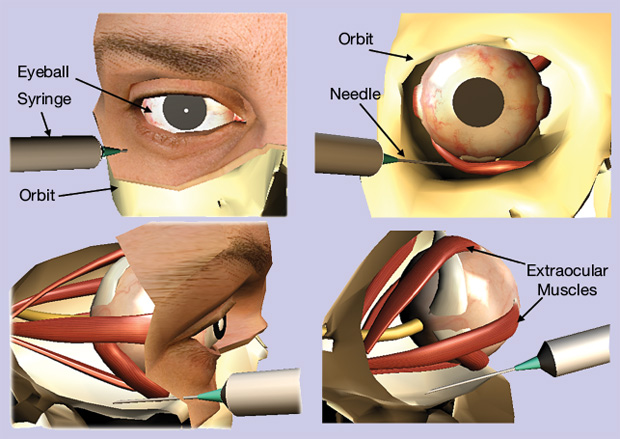 FIGURE 1 - An overview of the process of regional anesthesia delivery to the eye. The needle is penetrated through the skin at the inferotemporal quadrant of the eye. It is maneuvered to avoid needle injury to the globe or extraocular muscles. The anesthesia is then delivered at a safe rate, and the needle is retracted back along the same line. These techniques require several hours of practice to master, and presently, training is carried out on patients. (Figure used courtesy of [1].)