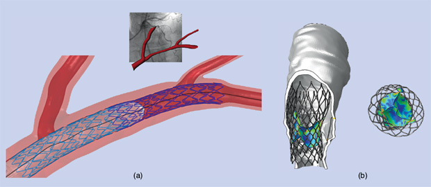 FIGURE 2 - (a) Virtual coronary stenting: from medical images to simulations. A longitudinal view, obtained by cutting a portion of aortic root, showing the postoperative configuration of the prosthetic valve. (Image courtesy of Francesco Migliavacca; more info can be found in [6].) (b) A computer-based simulation of a patient-specific transcatheter aortic valve implantation (TAVI) of the Corevalve device by Medtronic. The top view of the implanted device highlighting nonoptimal valve performance due to asymmetric postoperative placement (Image courtesy of Ferdinando Auricchio; more information is available in [7] and [8].)