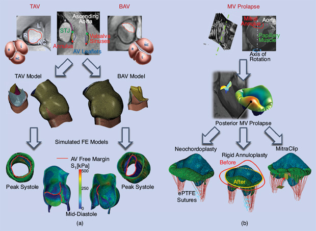 FIGURE 3 - A biomechanical evaluation of cardiac valves: (a) a comparison of tricuspid and bicuspid valve behavior and (b) from cardiac imaging to the simulation of three different mitral valve surgical corrections. (Image courtesy of Francesco Sturla; more info can be found in [9].) TAV: tricuspid aortica valve; BAV: bicuspid aortica valve; AV: aortic valve; STJ: sinotubular junction; MV: mitral valve; FE: finite element; ePTFE: expanded polytetrafluoroethylene.