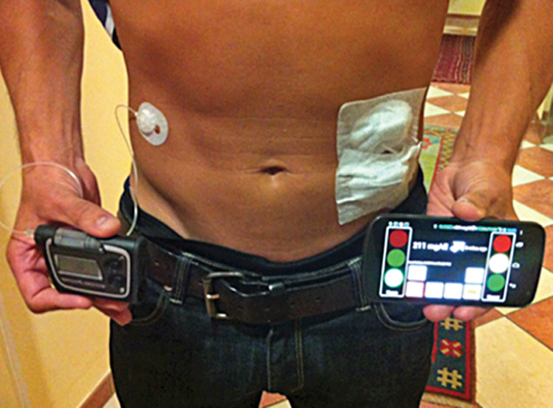 FIGURE 3 - The outpatient wearable AP system.