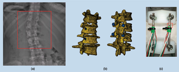 FIGURE 4 - (a) A planar X-ray image of the thoracolumbar spine of a scoliotic patient, (b) a finite-element model based on the radiographic image in which pedicle screws (in blue) are implanted to simulate the surgical correction of the spinal deformity, and (c) the experimental setup to test the strength of the pedicle screws and fixation rods used in the deformity correction surgery. (More information can be found in [14] and [15].)