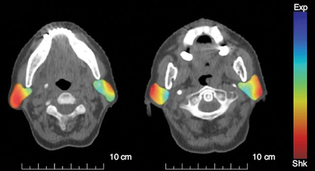 FIGURE 6 - Two CT images of the head and neck areas with the Jacobian map overlapping the parotid glands. As can be observed, the external part of the parotids are reduced using RT irradiation (red), while the internal part did not present deformation (light blue).