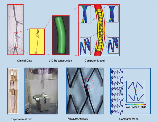 FIGURE 6 - An evaluation of the risk of stent rupture in cases of peripheral vascular angioplasty. This study used data from in vitro experiments on real stents and precomputed numerical simulations of diverse clinical cases personalized based on the patient conditions and suggest possible risks of stent rupture. Models such as these are, therefore, of great utility for physicians before a surgical operation as well as for engineers working in the biomedical industry. (For more information, see [17] and [18].)