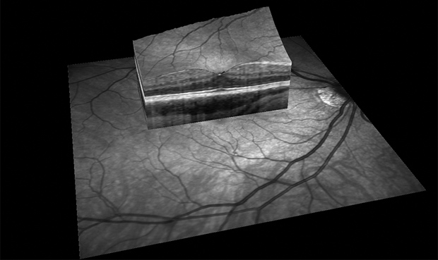 Figure 2: Newer technologies that blend viewing tools like OCT with SLO allow researchers to scan across the retina and down into the different layers of the eye. This image was taken using a Heidelberg SPECTRALIS OCT device. [Image courtesy of the VAMPIRE Project (Universities of Edinburgh and Dundee, United Kingdom).]