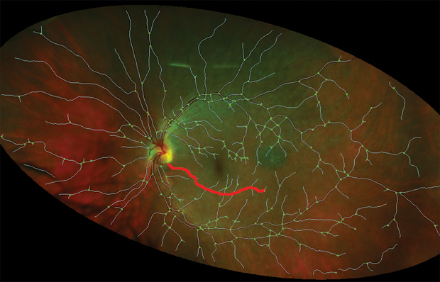 Figure 3: An image taken from an ultrawidefield SLO (P200C; Optos Plc, United Kingdom). The VAMPIRE team has developed automatic extraction of the blood vessels for this type of image to analyze vascular parameters such as vessel widths and pathways. [Image courtesy of the VAMPIRE Project (Universities of Edinburgh and Dundee, United Kingdom).]