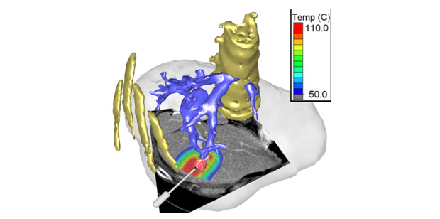 Figure 1: Computer simulation of image-guided thermal cancer therapy. Based on computed tomography (CT) images (grayscale image), the model geometry including tumor (red), vessels (purple), liver (translucent volume), and bones is created. Heating of tumor by a radiofrequency needle (white) is simulated, with temperature profile overlaid. Such simulations could guide the treating physician to determine ideal electrode placement and predict risk for potential damage to nearby tissues.