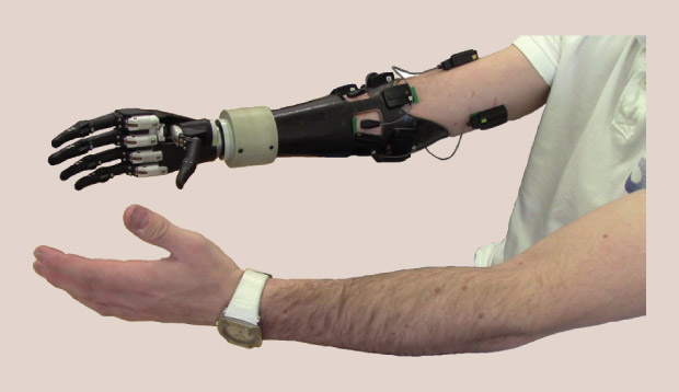 Figure 3: A patient wearing Nazarpour’s robotic hand. (Photo courtesy of Kianoush Nazarpour.)
