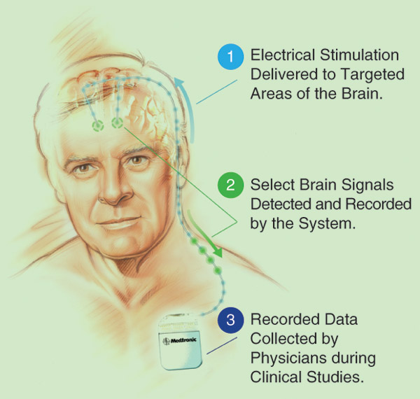 Figure S2: The Activa PC+S system includes a new brain– machine interface chip and a computer-in-the-loop algorithm that allow investigators to study the relationships between DBS and a patient’s symptoms. They hope to one day improve treatment by delivering the electrical impulses of DBS only when the patient needs them. (Image courtesy of Medtronic.)