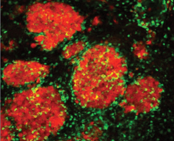 Figure S1: Khalid Shah’s research group at the Harvard Stem Cell Institute and Massachusetts General Hospital is developing stem cells that release tailor-made therapeutic proteins or oncolytic viruses specifically designed to kill an individual patient’s tumor cells. Here, therapeutic stem cells (green) target metastatic breast tumor deposits in the brain (red). (Photo courtesy of Khalid Shah.)