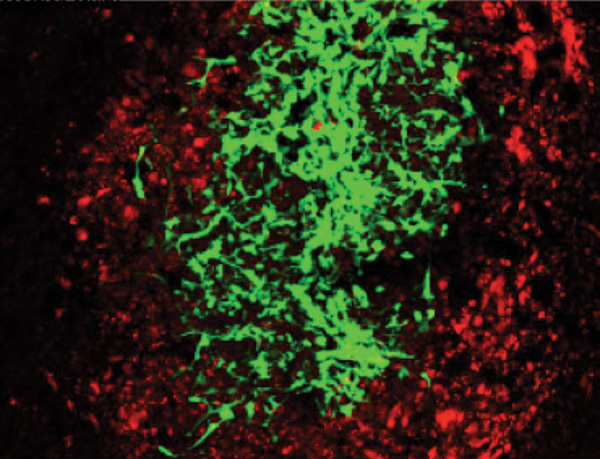 Figure S2: Therapeutic stem cells (green) encapsulated in gel and placed in a residual primary brain tumor (red). (Photo courtesy of Khalid Shah.)