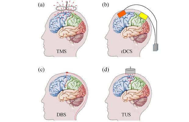 Figure 1. Demonstration of typical neuromodulation techniques: (a) transcranial magnetic stimulation (TMS), (b) transcranial direct current stimulation (tDCS), (c) Deep brain stimulation (DBS), and (d) transcranial ultrasound stimulation.
