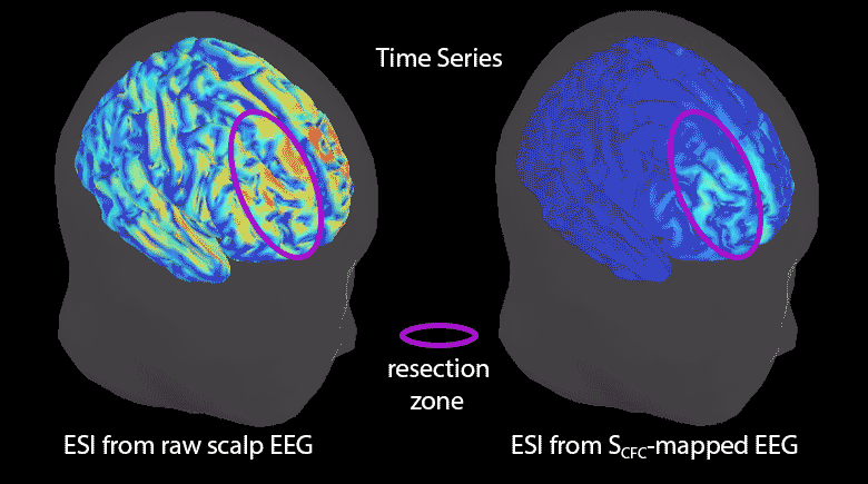 Epileptogenic Source Imaging Using Cross Frequency Coupled Signals from Scalp EEG