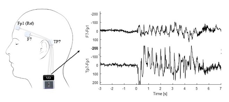 Detection of Paroxysms in Long-Term, Single Channel EEG-Monitoring of Patients with Typical Absence Seizures