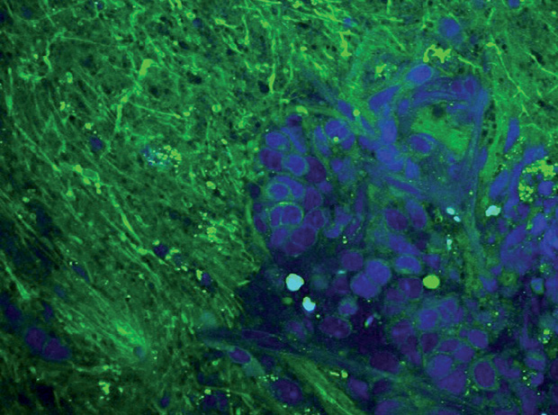 Figure 2: With the new microscope, surgeons can see the difference between normal brain and brain-tumor tissue. Normal brain tissue contains sparse cells (blue) with bundles of nerve fibers (green), as seen in the left side of the image. Brain-tumor tissue is laden with a disordered pattern of cells, as seen at the right. (Image courtesy of Daniel Orringer.)