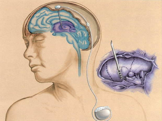 Figure 2: With DBS, an electrode is implanted into the brain to deliver electrical signals driven by a battery-powered stimulator placed underneath the skin. (Image courtesy of Andres Lozano.)