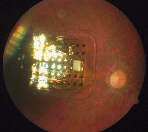 Figure 3: A microelectrode array attached to the retina. (Photo courtesy of Second Sight.)